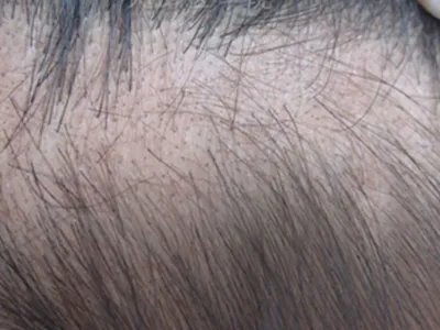 黑点癣头皮症状图片