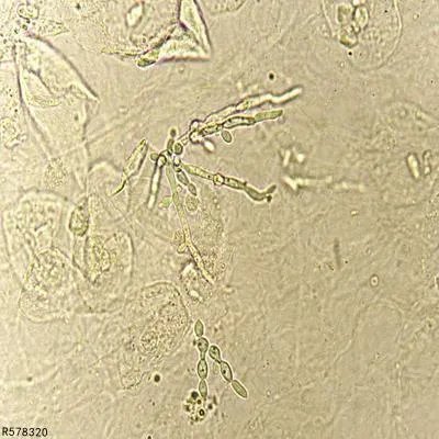 白带里有黑丝是怎么回事