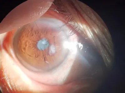 外伤性白内障症状图片