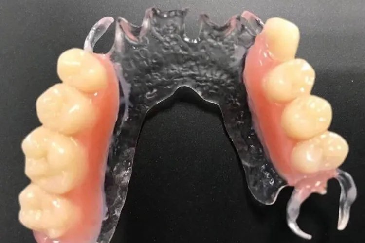 可摘局部义齿图片