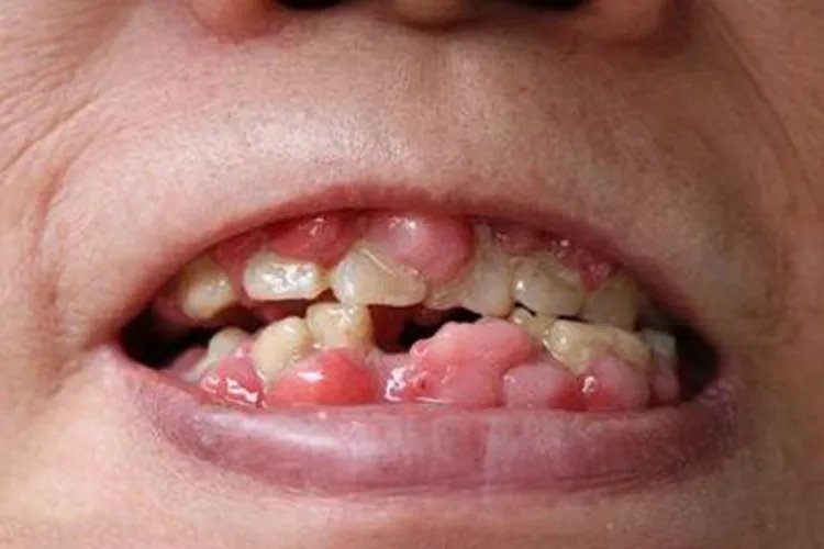 牙齿被肉包住了图片