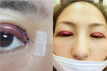 割双眼皮恢复过程图需要多长时间