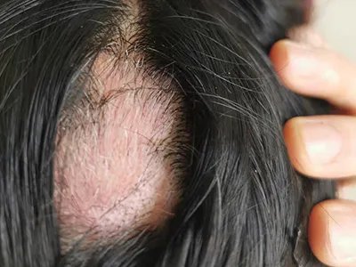 稳定期节段型白癜风头皮白斑图片