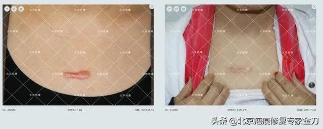 疤痕疙瘩是怎么形成的，有什么好的治疗方法？