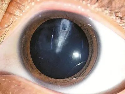 外伤性白内障症状图片