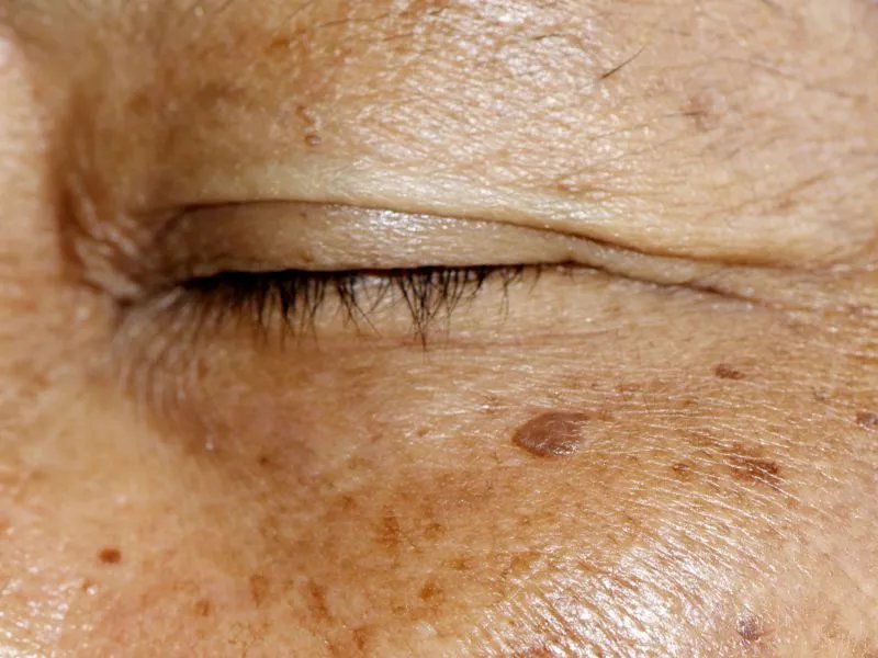 老年斑的预防措施有哪些