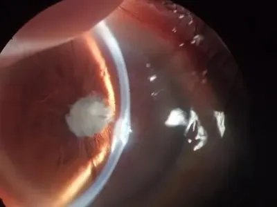 外伤性白内障症状图片