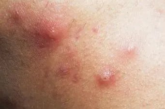 徐州哪家医院治痤疮好