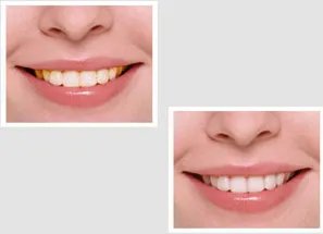 四环素牙如何变白