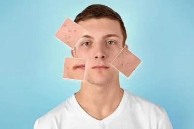 聚合性痤疮应该做哪些检查 聚合性痤疮需做这些检查