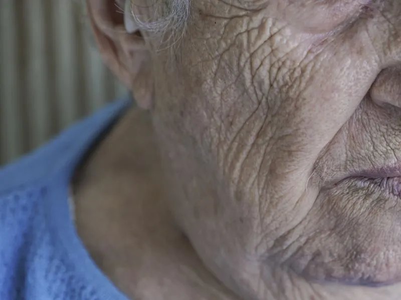 嘴角有皱纹怎么办