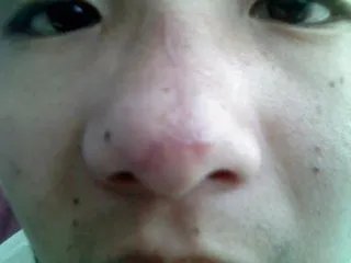 瘢痕疙瘩能治好吗