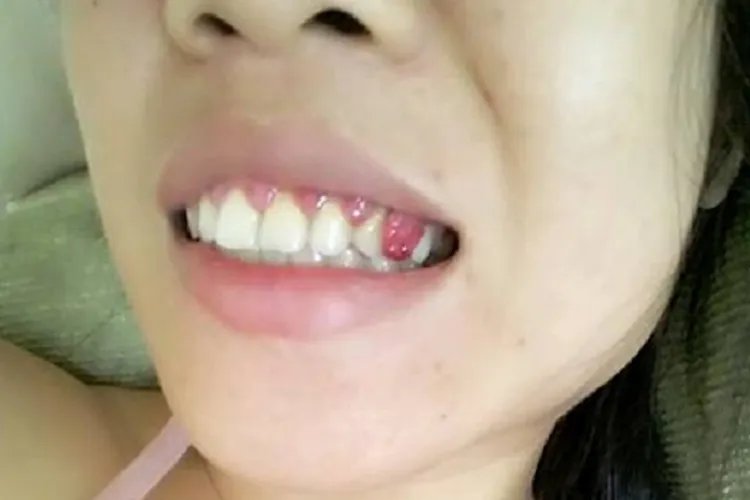 牙齿被肉包住了图片