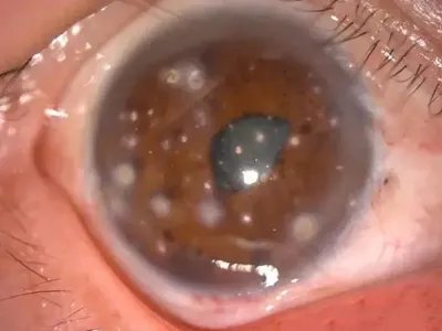 外伤性白内障症状图片