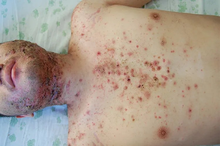 起痘痘的位置和原因