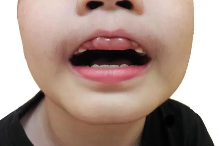 牙齿被肉包住了图片