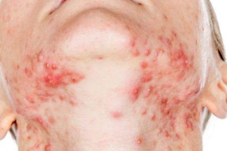 起痘痘的位置和原因