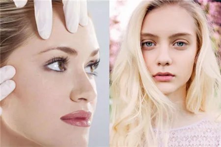 割双眼皮恢复过程图需要多长时间