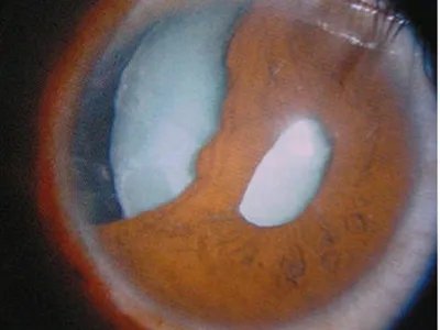 外伤性白内障症状图片