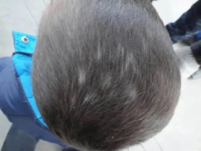 黑点癣头皮症状图片