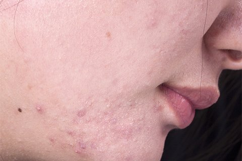 祛痘去痘印的方法