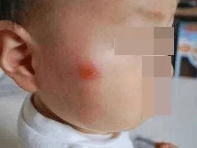 蚊子叮咬及引起的皮肤反应风团图片