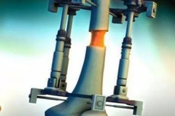 小伙身高不足一米八断骨增高致残疾，男生没有一米八真的会受歧视吗？