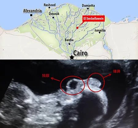 独眼喙鼻畸形孩子 畸形孩一般是怎么形成的揭晓