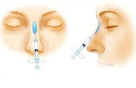 玻尿酸隆鼻价格大概要多少钱