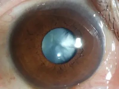 外伤性白内障症状图片