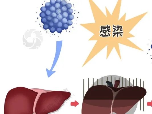 “掏空”肝脏的3个坏习惯，很多人天天做，难怪肝病会不请自来