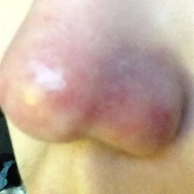 鼻咽炎如何治疗?