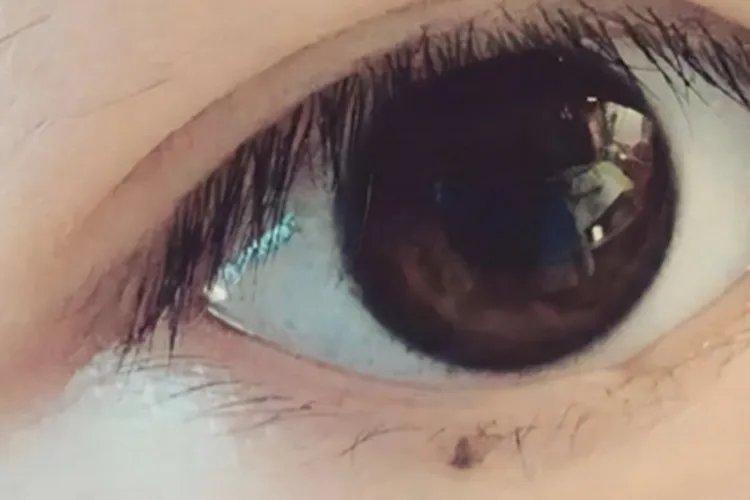 眼睑交界痣黑痣图片