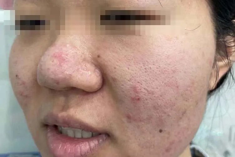 起痘痘的位置和原因