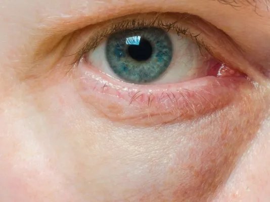 眼睛周围肿是怎么回事