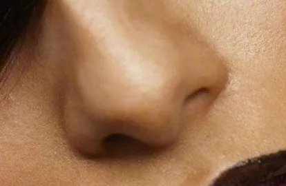假体隆鼻术后效果自然吗