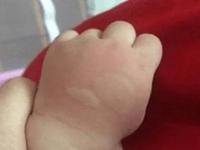 蚊子叮咬及引起的皮肤反应风团图片