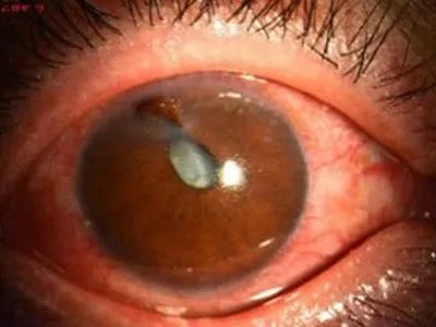 外伤性白内障症状图片