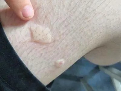 蚊子叮咬及引起的皮肤反应风团图片