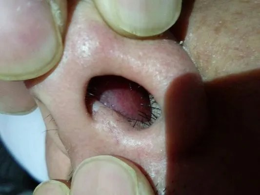 长期鼻窦炎该怎么治疗？