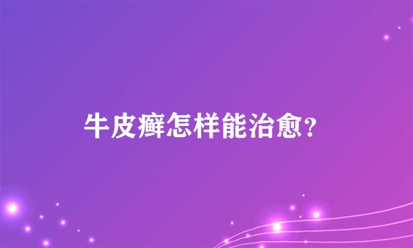 牛皮癣怎样能治愈？