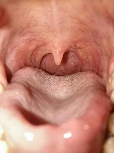 结核病早期症状能治好吗?