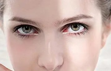 怎么减少鱼尾纹