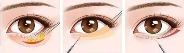 怎样减轻眼袋？